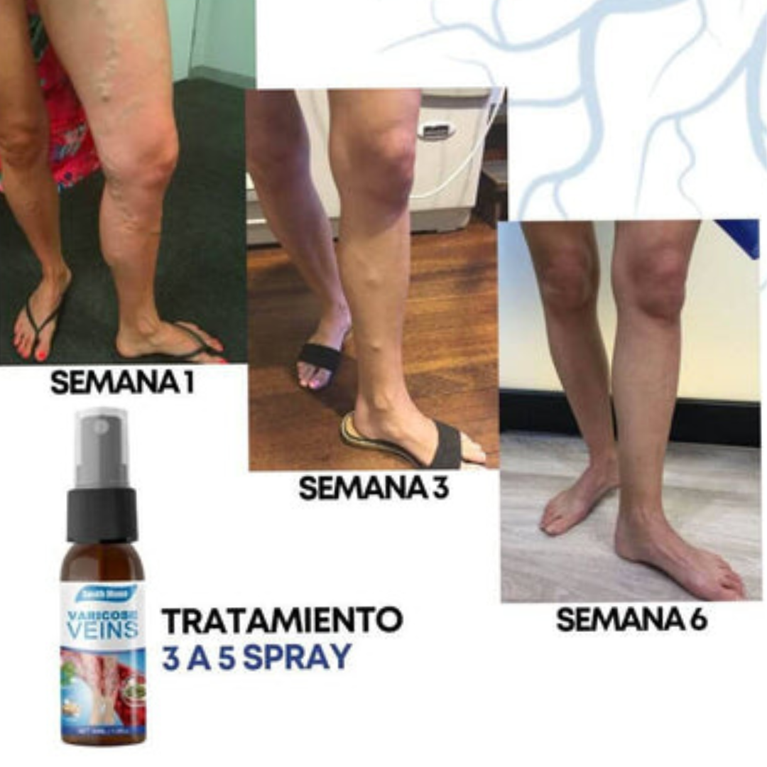 Eliminador de  venas varice: Reactiva la movilidad y flexibilidad de las piernas