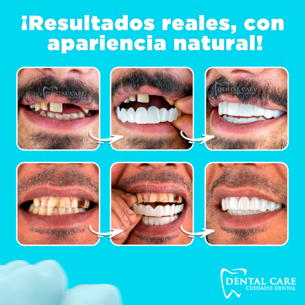 Carillas Dentales Snapon Smile